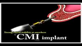 NeoBiotech CMI implant Concept