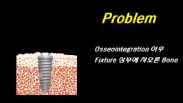 Neobiotech Surgical Accessory Kit  Bone Profile