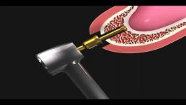 Neobiotech Sinus Lift Solution  SCA Kit Procedure