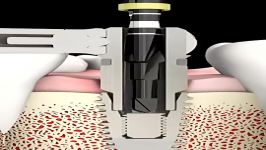 NeoBiotech Repair Solutions  SR Kit