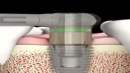 NeoBiotech Repair Solutions  SR Kit ReverseDrill