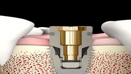 NeoBiotech Repair Solutions  SR Kit Perfect Guide