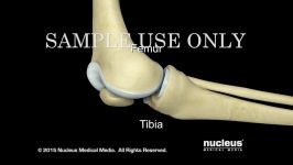 Total Knee Replacement Surgery  Nucleus Health