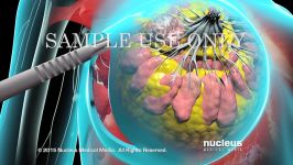 Breast Cancer  Tumor Removal Surgery  Nucleus Health