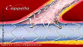 Stent insertion