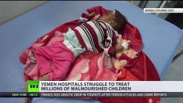 1.5 million children severely malnourished as humanitarian crisis grips Yemen DISTURBING