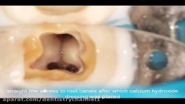 درمان ریشه دندان آبسه شدید