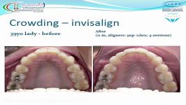 همه چیز در باره الاینرهای شفاف یا ارتودنسی نامرئی  23