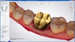 3shape Full Anatomical Crown on a TRIOS® Scan