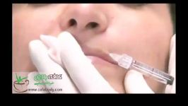 تزریق ژل به لبها Lip Gel Injection 