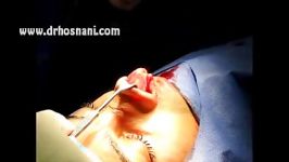 Open rhinoplasty nose surgery by Dr HOSNANI Iranian nose surgeon