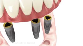 Full arch Implant Bridge