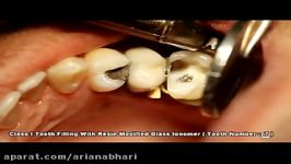 ترمیم دندان گلاس آینومردکتردوستی Glass Ionomer 3