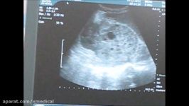 How To Take Ultrasound Guided Biopsy Of Kidney With ...