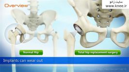 Revision Hip Replacement