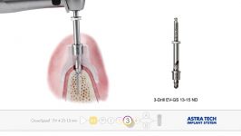 استفاده گاید جراحی سیستم ایمپلنتASTRA TECH