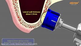 کیت جراحی ایمپلنت Hiossen Osstem LAS KIT