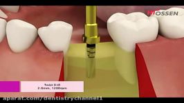 نصب ایمپلنت Hiossen Osstem ETIII کیت مخروطی