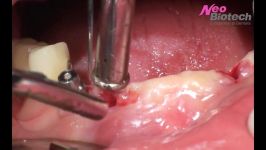 Removal of a fractured implant screw