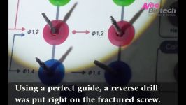 Removal of a fractured implant screw 2