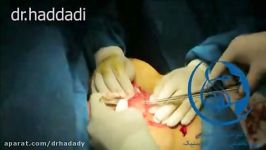جراحی ماموپلاستی توسط دکتر شهریار حدادی