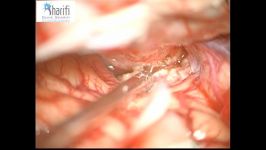 41.مننژیومای عصب بیناییOptic Nerve Meningioma