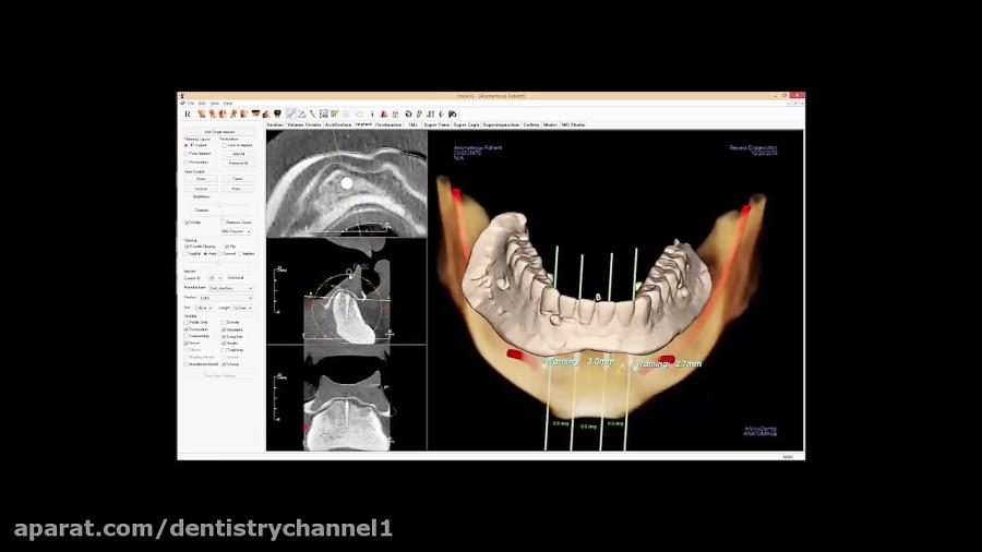 راهنمای طراحی جراحی ایمپلنت های Zest