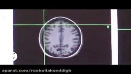 Electro Medicine Transcranial Magnetic Stimulation TMS