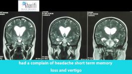 40.کلوئید کیست Colloid Cyst