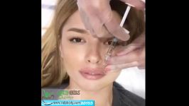 تزریق ژل به لبها Lip Gel Injection 