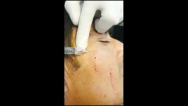 Wrinkles filler injection technique by Dr.Amir Feily