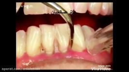 آیا جرمگیری باعث بین رفتن مینای دندان می شود