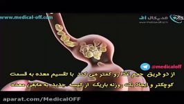 مدیكال آف  انواع جراحی ها برای كاهش وزناسلیو معده