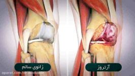 آیا درد آرتروز رنج می برید؟ این ویدئو رو حتما ببینید