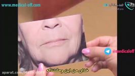 مدیکال آف  لایه برداری شیمیایی پوست صورت