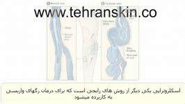 چگونه اسکلروتراپی واریس را درمان میکند ؟