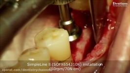 کاشت ایمپلنت Dentium Simpleline در ناحیه خلفی فک پایین