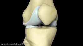 تعویض کامل مفصل زانو Total Knee Replacement