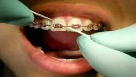 طریقه صحیح استفاده نخ دندان دندان های ارتودنسی شده