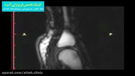 تصویر MRI حین شکستن قولنج انگشت دست