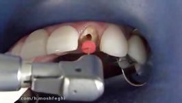نحوه باز سازی دندان استفاده پست کور