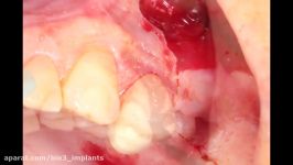 Placement of Dental Implant Bio3 to the lower jaw