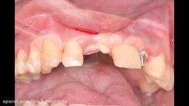 Bio3 Implants clinical case