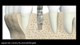 خلاصه مراحل جراحی ایمپلنت دندانی Dental Implant