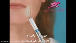 تزریق فیلر برای رفع خطوط افتادگی گوشه لب