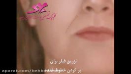 تزریق فیلر برای پر کردن خطوط خنده