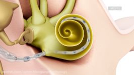 Electric Acoustic Stimulation Hybrid Cochlear Implant for High Frequency Hearing Loss—MED EL