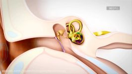 Mixed Hearing Loss Sensorineural and Conductive Hearing Loss  MED EL