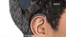 How do Cochlear Implants Work The SYNCHRONY Cochlear Implant—MED EL