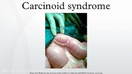 Carcinoid syndrome